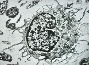 F,43y. | blood - hairy cell leukemia F,43y. | blood - hairy cell leukemia